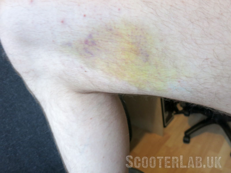 No bruises where the armour was, but nearby...