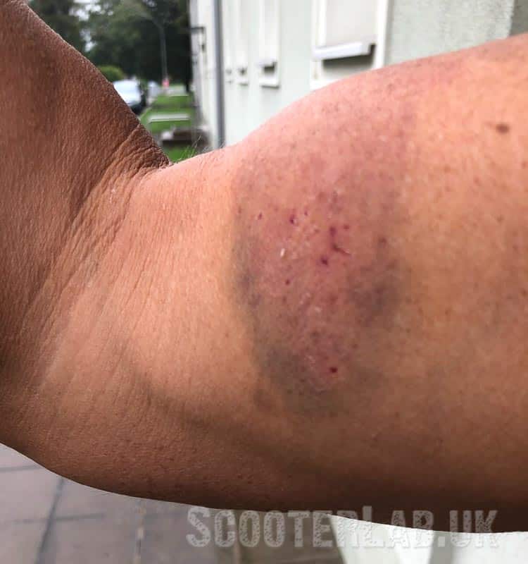 Günter's injured arm